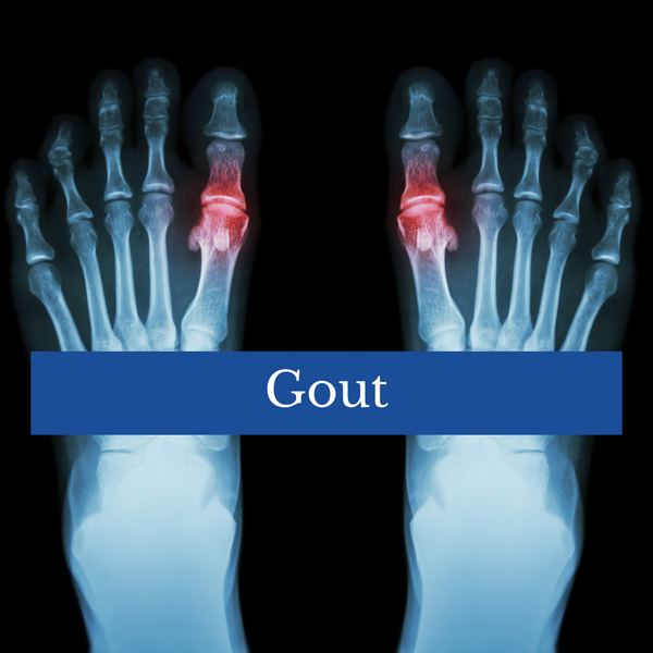 Gout - What is it & What can you do for relief
